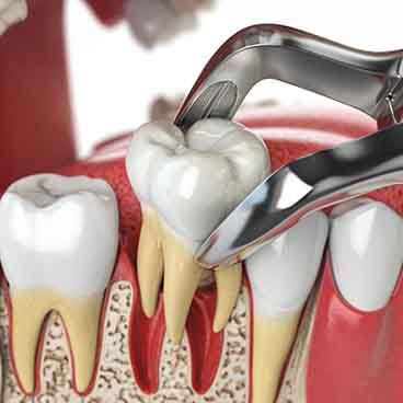 Rendering of tooth being removed with forceps