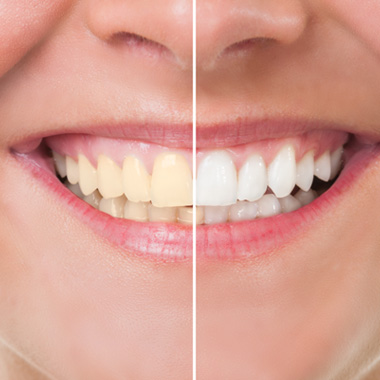 Closeup of a smile that’s half whitened to show before/after results